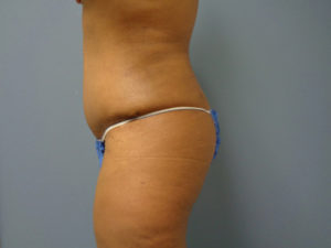 Tummy Tuck Before and After Pictures Nashville, TN