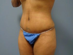 Tummy Tuck Before and After Pictures Nashville, TN