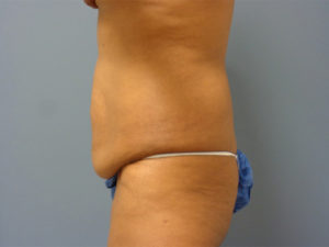 Tummy Tuck Before and After Pictures Nashville, TN