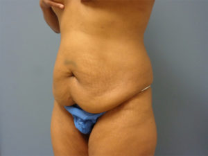 Tummy Tuck Before and After Pictures Nashville, TN