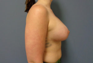 Breast Augmentation with Lift Before and After Pictures Nashville, TN