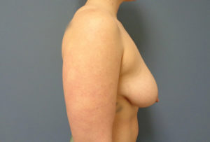 Breast Augmentation with Lift Before and After Pictures Nashville, TN