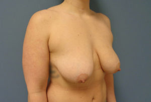 Breast Augmentation with Lift Before and After Pictures Nashville, TN