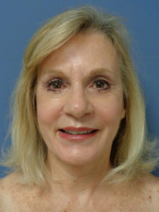 Facelift Before and After Pictures Nashville, TN