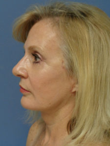 Facelift Before and After Pictures Nashville, TN