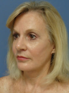 Facelift Before and After Pictures Nashville, TN