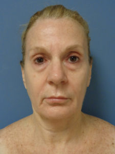 Facelift Before and After Pictures Nashville, TN