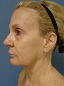 Facelift Before and After Pictures Nashville, TN