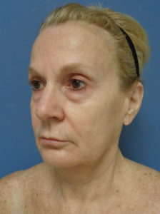 Facelift Before and After Pictures Nashville, TN