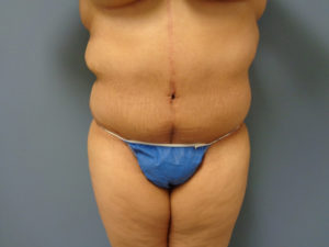 Tummy Tuck Before and After Pictures Nashville, TN