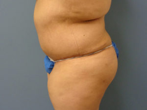 Tummy Tuck Before and After Pictures Nashville, TN