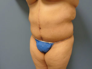 Tummy Tuck Before and After Pictures Nashville, TN