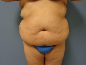 Tummy Tuck Before and After Pictures Nashville, TN