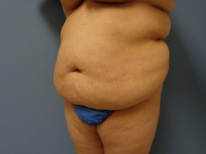 Tummy Tuck Before and After Pictures Nashville, TN