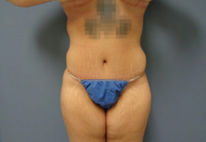 Abdominoplasty Before & After Pictures in Nashville, TN