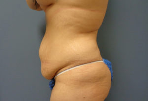 Tummy Tuck Before and After Pictures Nashville, TN