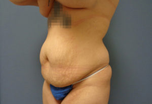 Abdominoplasty Before & After Pictures in Nashville, TN