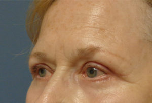 Blepharoplasty Before and After Pictures Nashville, TN