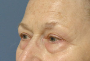 Blepharoplasty Before and After Pictures Nashville, TN