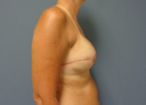 Breast Reconstruction Before and After Pictures Nashville, TN