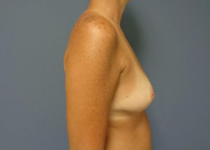 Breast Reconstruction Before and After Pictures Nashville, TN