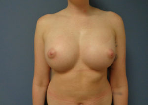 Breast Augmentation Before and After Pictures Nashville, TN