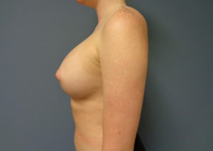 Breast Augmentation Before and After Pictures Nashville, TN