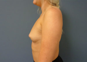 Breast Augmentation Before and After Pictures Nashville, TN