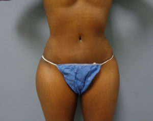 Tummy Tuck Before and After Pictures Nashville, TN