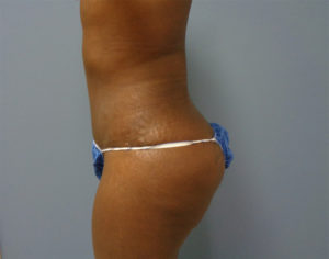 Tummy Tuck Before and After Pictures Nashville, TN