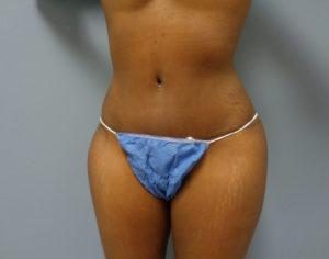 Tummy Tuck Before and After Pictures Nashville, TN