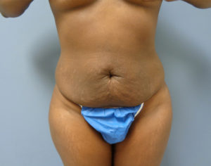 Tummy Tuck Before and After Pictures Nashville, TN