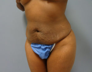 Tummy Tuck Before and After Pictures Nashville, TN