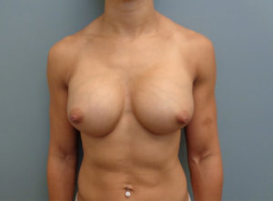 Breast Augmentation with lift Before & After Pictures in Nashville, TN