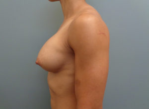 Breast Augmentation Before and After Pictures Nashville, TN