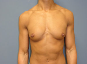 Breast Augmentation Before and After Pictures Nashville, TN