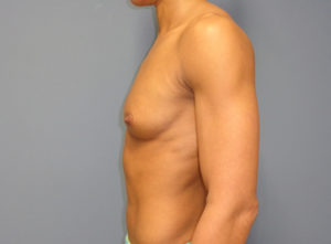 Breast Augmentation Before and After Pictures Nashville, TN