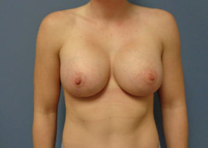 Breast Augmentation with Lift Before and After Pictures Nashville, TN