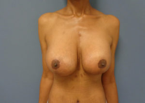 Breast Augmentation with Lift Before and After Pictures Nashville, TN