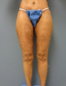 Thigh Lift Before and After Pictures Nashville, TN