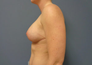 Breast Augmentation with Lift Before and After Pictures Nashville, TN