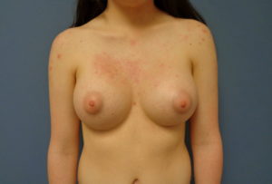 Breast Augmentation Before and After Pictures Nashville, TN