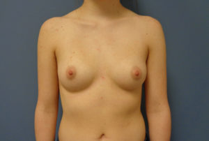 Breast Augmentation Before and After Pictures Nashville, TN