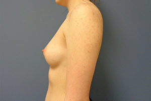 Breast Augmentation Before and After Pictures Nashville, TN