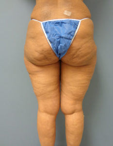 Thigh Lift Before and After Pictures Nashville, TN
