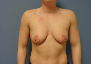 Breast Augmentation with Lift Before and After Pictures Nashville, TN