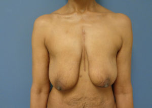 Breast Augmentation with Lift Before and After Pictures Nashville, TN