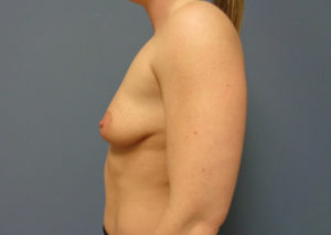 Breast Augmentation with Lift Before and After Pictures Nashville, TN