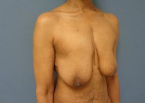 Breast Augmentation with Lift Before and After Pictures Nashville, TN