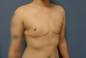 Transgender-Female to Male Before and After Pictures Nashville, TN